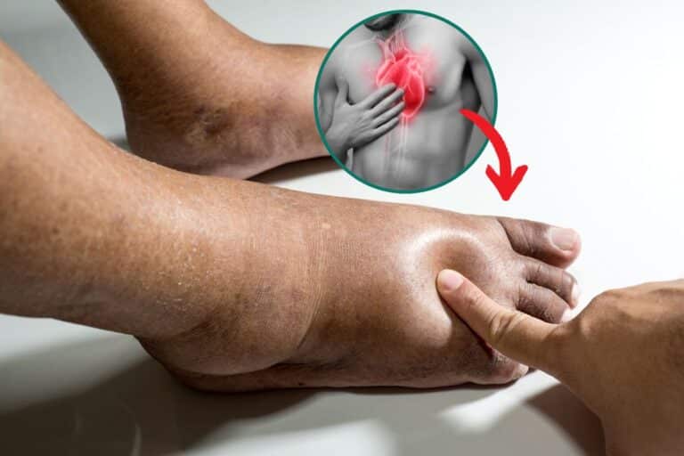 Pés Inchados e Insuficiência Cardíaca: entenda a relação e os sinais precoces 8 Pés inchados e insuficiência cardíaca.