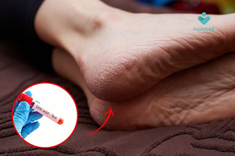 ácido úrico elevado causa rachadura nos pés.