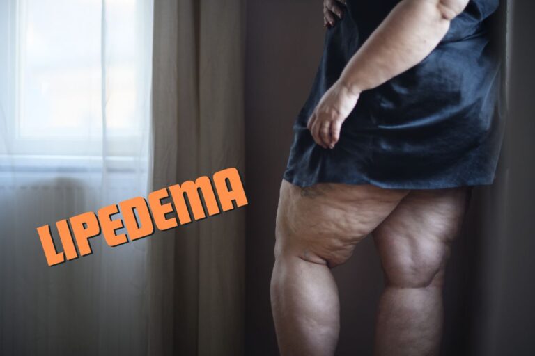O que é lipedema? Tudo que você sempre quis saber 8 O que é lipedema.