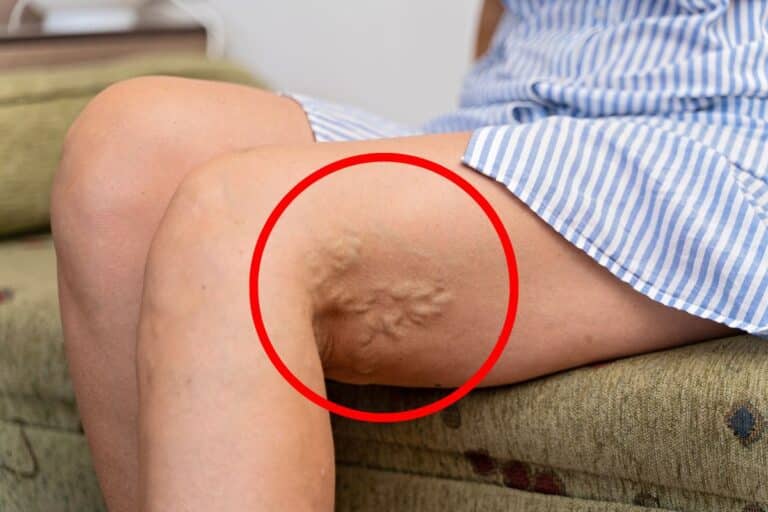 Trombose: principais causas, tipos e como prevenir 1 Trombose.