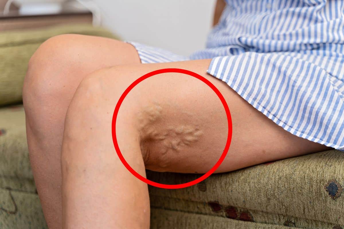 Trombose: principais causas, tipos e como prevenir 1 Trombose.