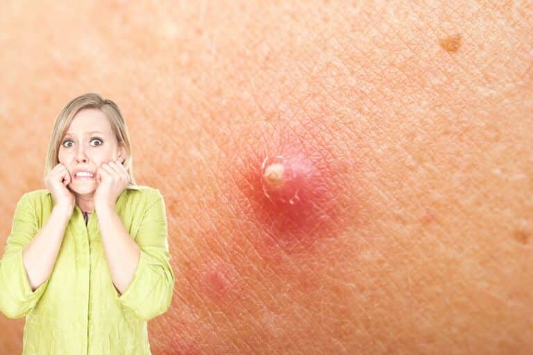 Furúnculo é contagioso? Entenda as causas, sintomas e prevenção 6 Furúnculo é contagioso?