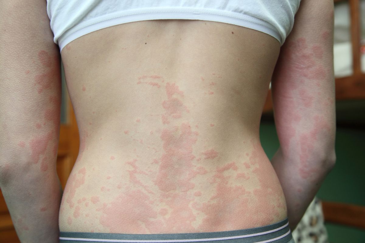 Estresse pode agravar inflamações alérgicas na pele, aponta estudo 1 estresse e alergias na pele