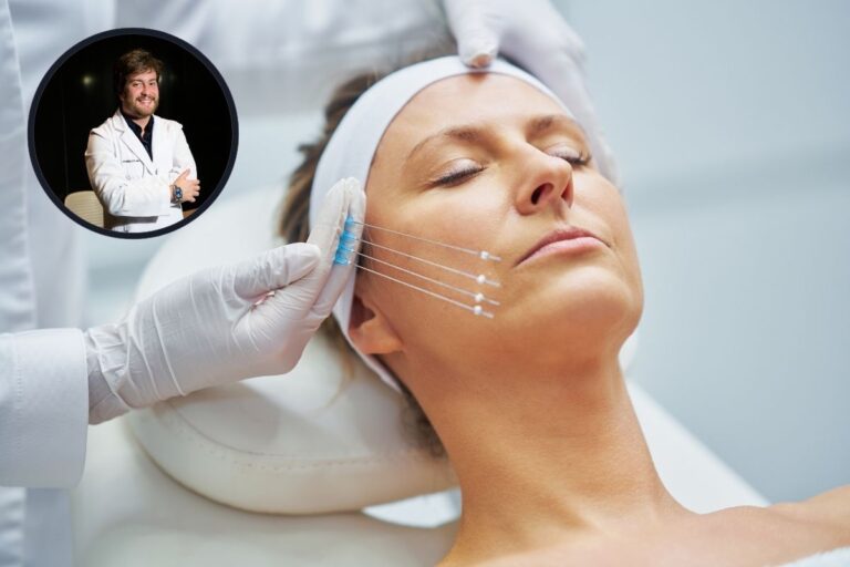 Fios de Sustentação: Rejuvenescimento Sem Cirurgia 2 Fios de sustentação.