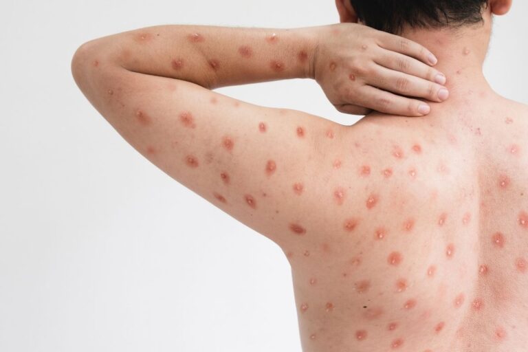 O que é Mpox e quais seus sintomas? Nova variante chega ao Brasil e é 10 vezes mais perigosa 4 O que é Mpox?