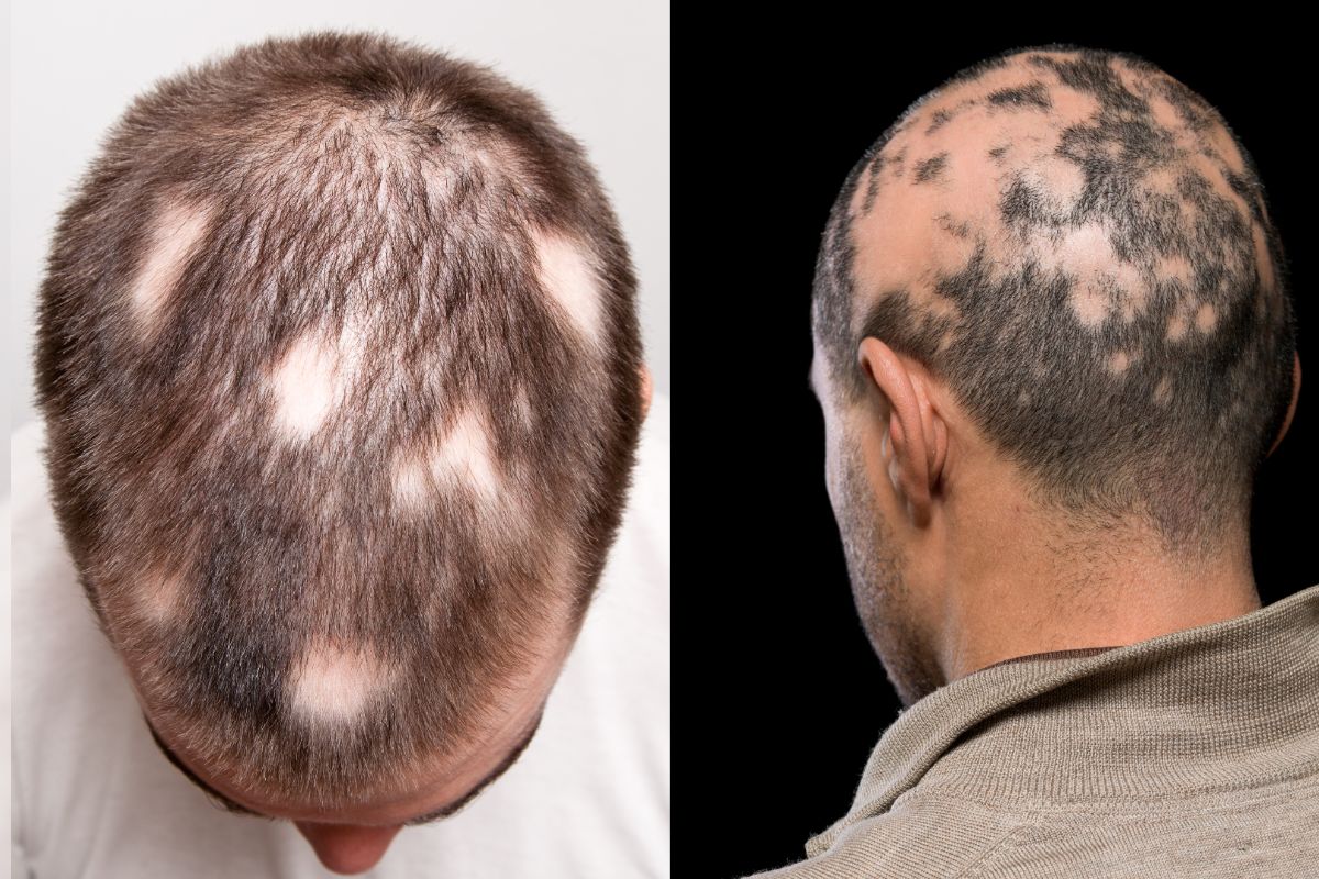 O que é alopecia areata? Estudo revela avanço que pode mudar o futuro do tratamento 1 O que é alopecia areata?