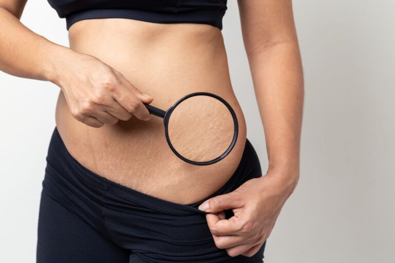 Corpo feminino com estrias.