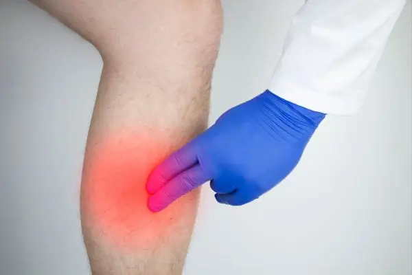 Você conhece os sinais de trombose na perna? Saiba quando se preocupar 2 Sinais de trombose na perna.