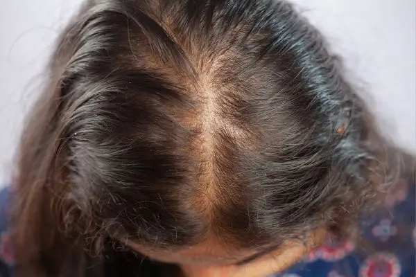 Cabelo oleoso? Como problemas hormonais podem afetar seus fios 2 Mulher com cabelo oleoso e alopecia.