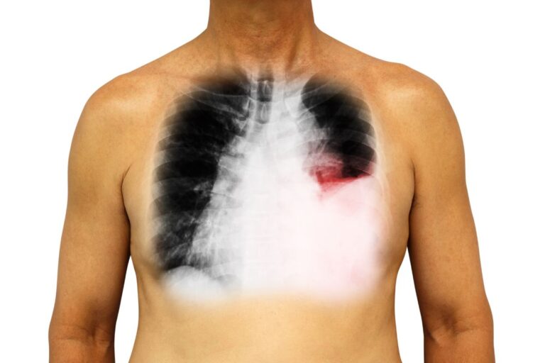 O que causa água no pulmão? Entenda os sintomas, causas e tratamentos 8 Homem com água no pulmão.