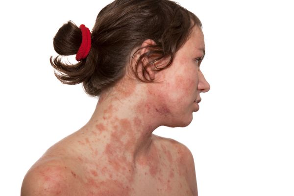 Dermatite atópica (eczema): o que é, sintomas, causas e como tratar 2 dermatite atópica ou eczema