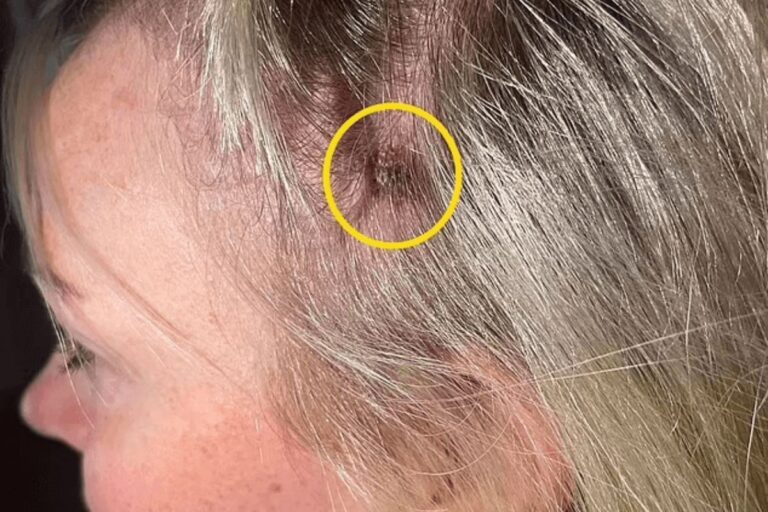 A cabeleireira dela ajudou a descobrir um melanoma no couro cabeludo e salvou sua vida 1 melanoma no couro cabeludo.