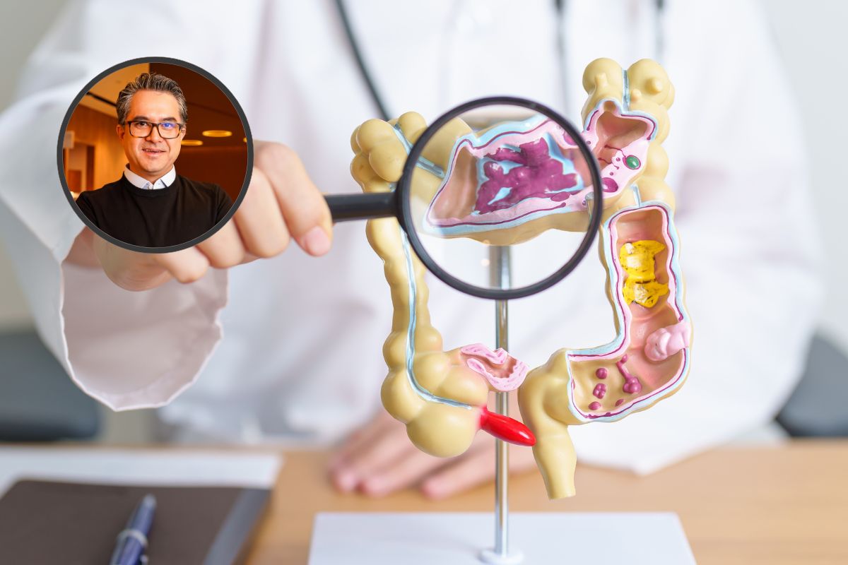 Câncer de intestino pode voltar e médico orienta o que fazer para reduzir esse risco 1 câncer de intestino pode voltar.