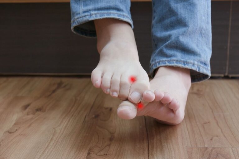 Frieira (Pé-de-atleta): o que é, sintomas, tratamento e como evitar 3 Frieira ou pé-de-atleta.