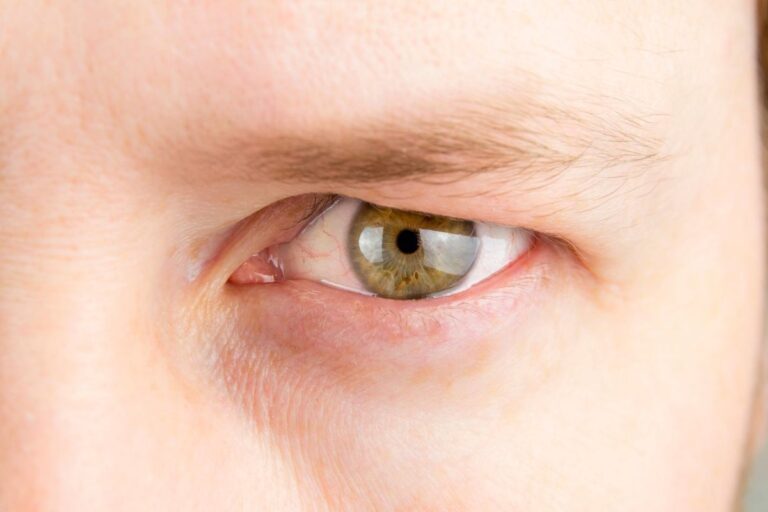 Pálpebra caída: o que fazer e quando pode ser ptose palpebral? 1 Pálpebra caída e ptose palpebral.