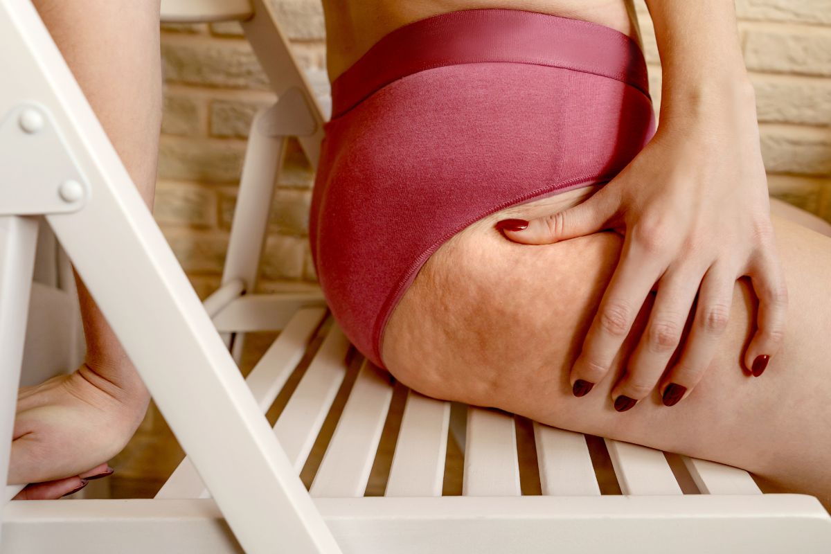 Suplementação para lipedema: o que funciona e o que evitar, segundo a ciência 1 suplementação para lipedema.
