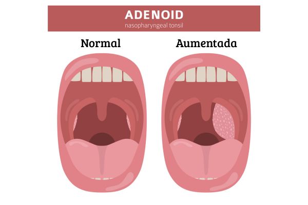 Hipertrofia de Adenoide: o que é, sintomas, tratamento e quando operar 2 Adenoide.