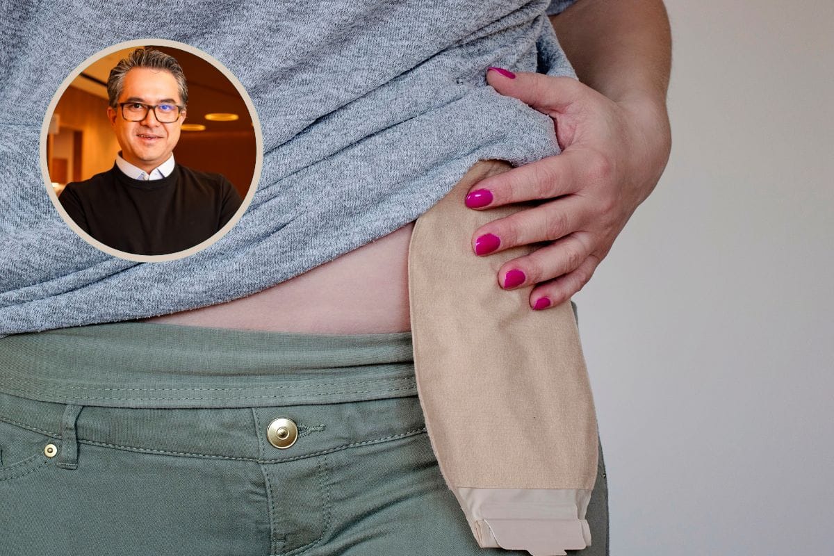 Ostomia sem tabu: médico revela verdades sobre o procedimento que salva vidas 1 O que é ostomia.