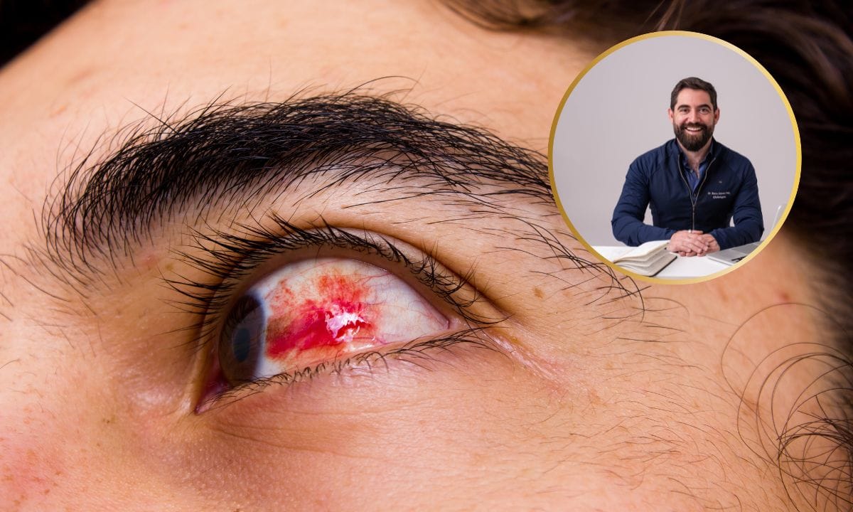 Saiba por que o derrame ocular aparece de repente e quando merece atenção 1 Derrame ocular.