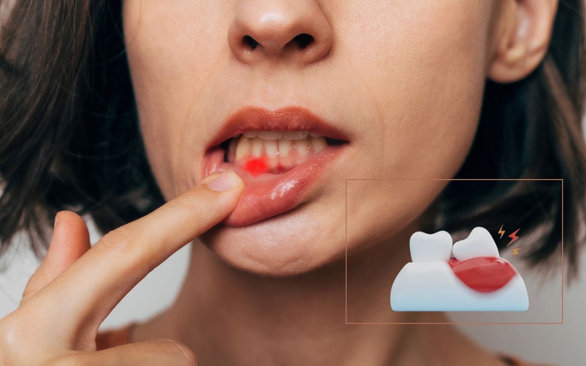 Sangramento e inchaço na gengiva? Estudo sugere que um tipo de alimentação pode ajudar 1 dieta mediterrânea e saúde bucal.