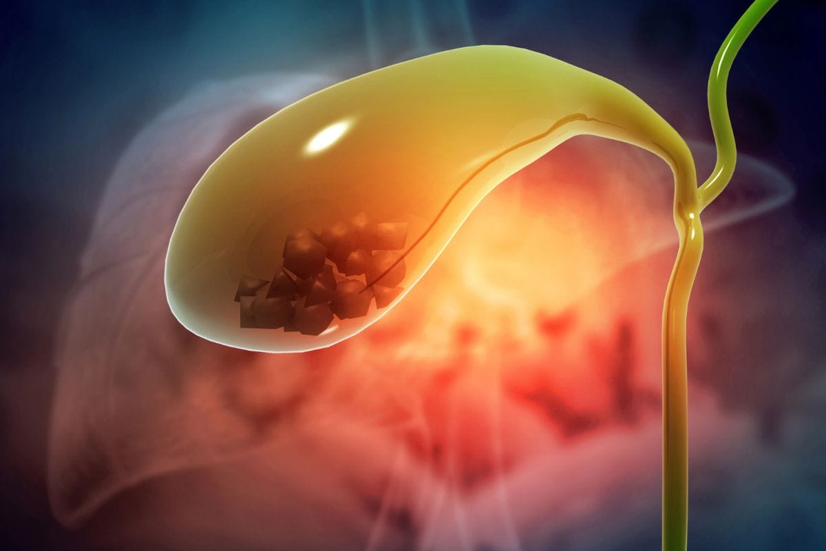 Sintomas de pedra na vesícula: quando a dor na barriga pode ser sinal de alerta 1 sintomas de pedra na vesícula.