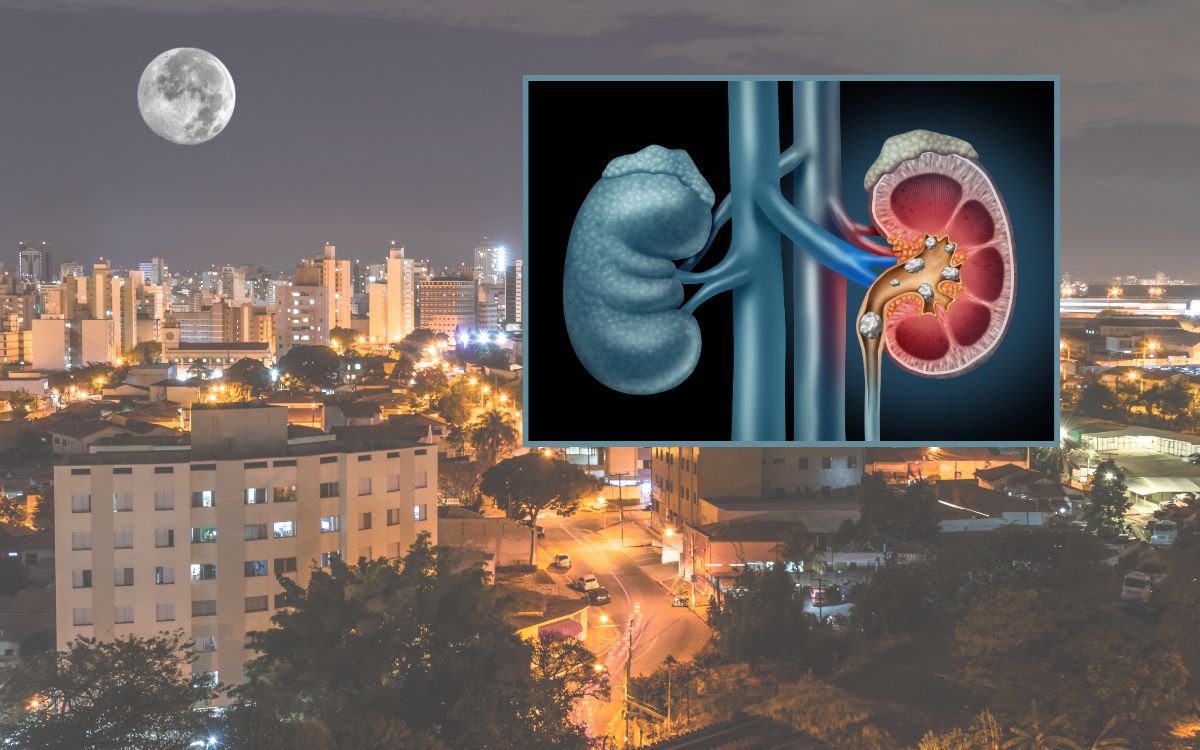 Trabalho noturno aumenta risco de pedras nos rins? Estudo revela resposta 1 Trabalho noturno aumenta risco de pedras nos rins