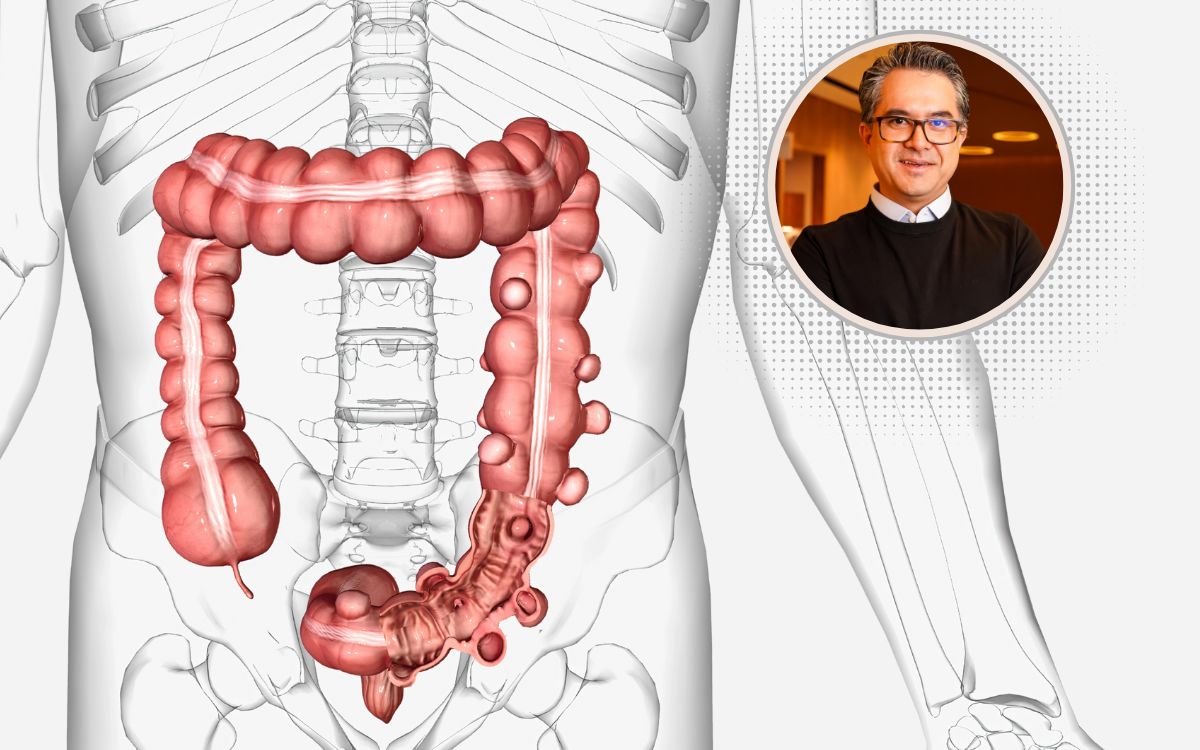 Diverticulite pode virar câncer? Entenda o que realmente acontece no intestino 1 diverticulite pode virar câncer.