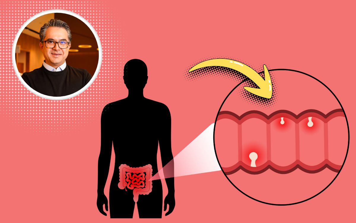 SaúdeLAB - Notícias e Conteúdos Sobre Saúde e Bem-Estar 5 o que são pólipos intestinais.