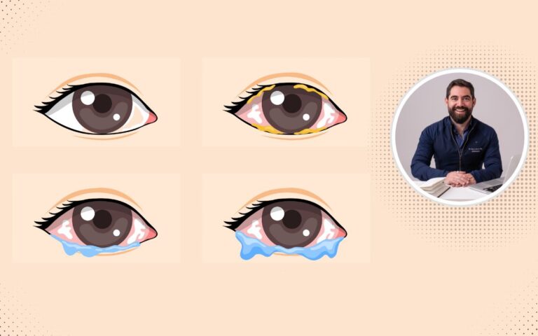 O que seus olhos estão tentando dizer? Descubra os principais tipos de conjuntivite e como tratá-los 2 tipos de conjuntivite.