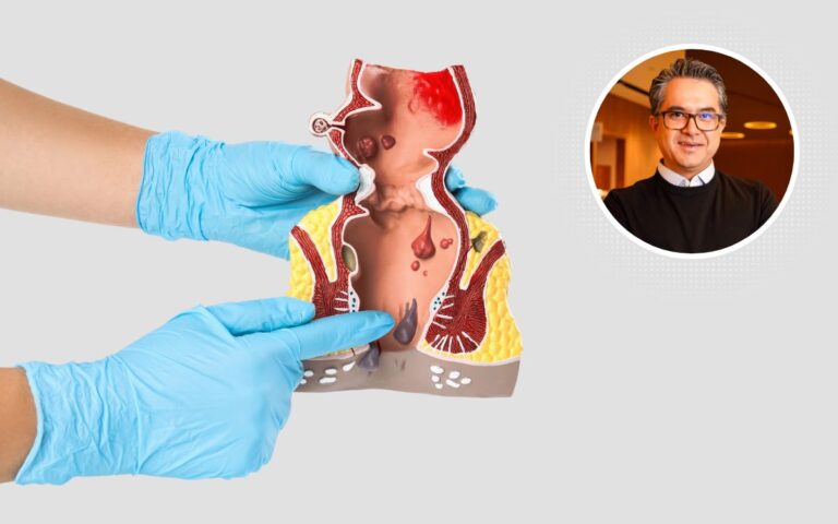 Cirurgia de hemorroidas sem cortes.