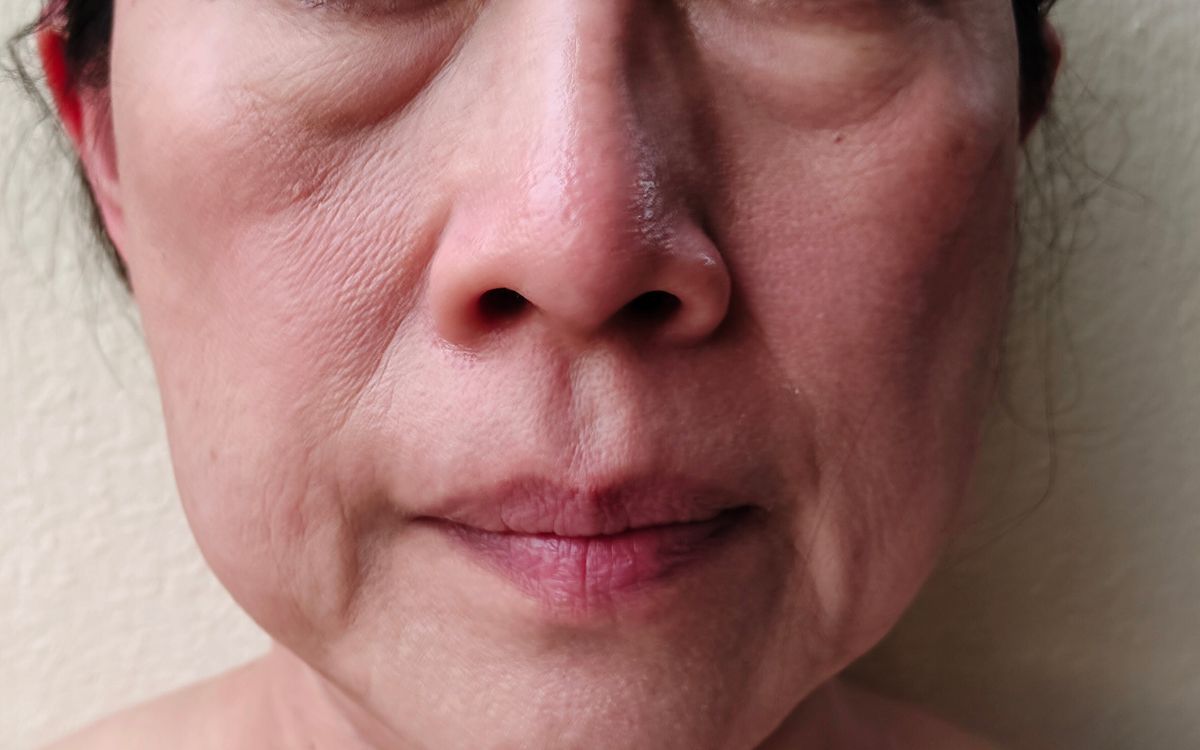 Ozempic face: o que o emagrecimento rápido faz no seu rosto 1 Ozempic face.