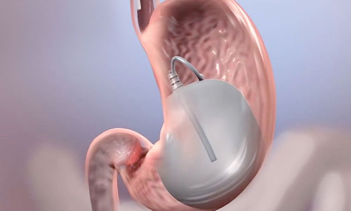 balão intragástrico