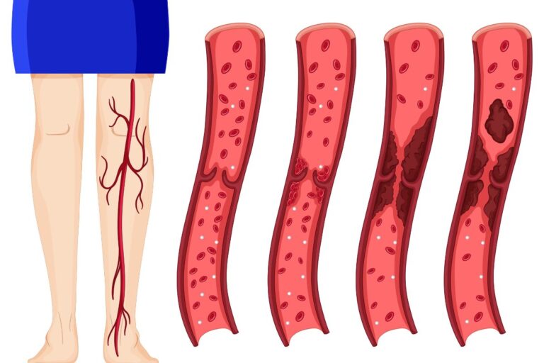 Cardiolipina: o que é, para que serve o exame e o que significa ter anticardiolipina alta 2 cardiolipina.