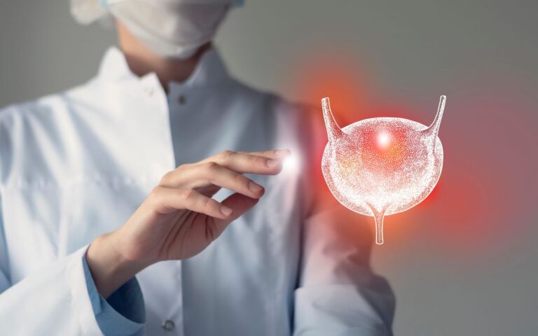 Ele está no corpo de quase todos — e pode influenciar um tipo de câncer 2 câncer de bexiga.