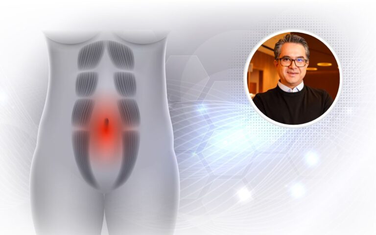 cirurgia de diástase diminui a barriga.