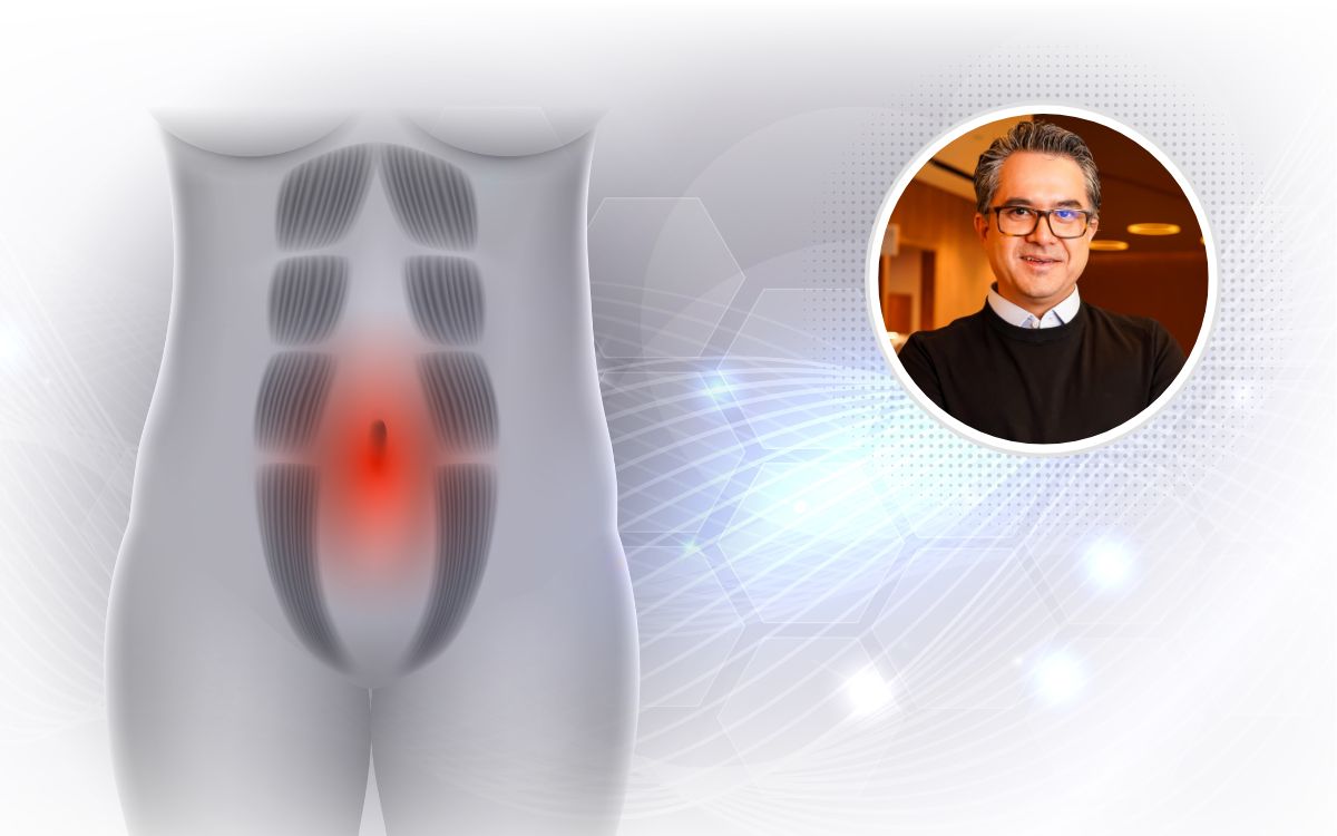 cirurgia de diástase diminui a barriga.