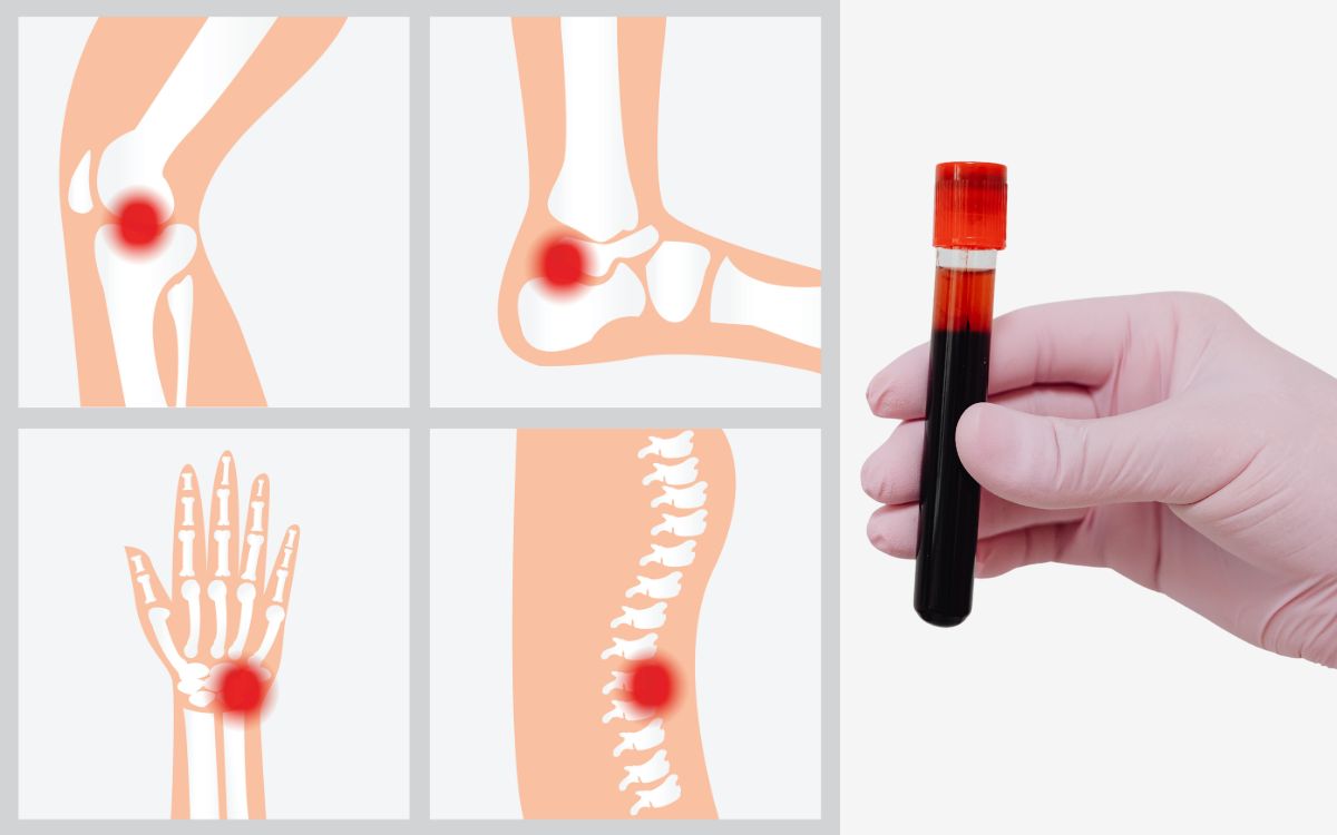 Fosfatase alcalina alta pode alertar para osteoporose 1 fosfatase alcalina alta.