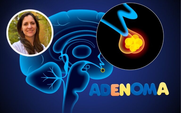 Especialista explica o que é adenoma de hipófise, seus riscos e os primeiros sinais 2 adenoma de hipófise.