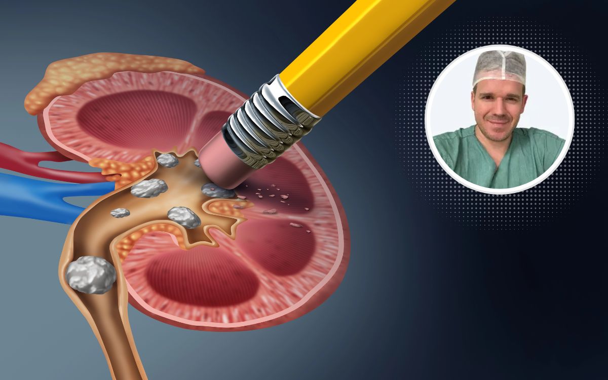 A dor vai embora, o risco fica: como evitar novas cólicas renais 1 prevenção do cálculo renal