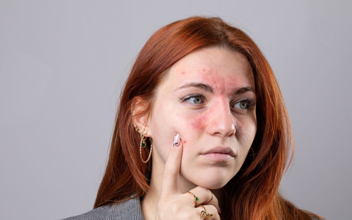 O que é rosácea