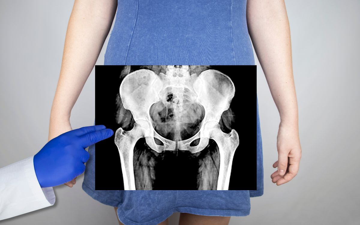 Seu prato pode estar afetando seus ossos mais do que você imagina 2 Ultraprocessados podem enfraquecer os ossos