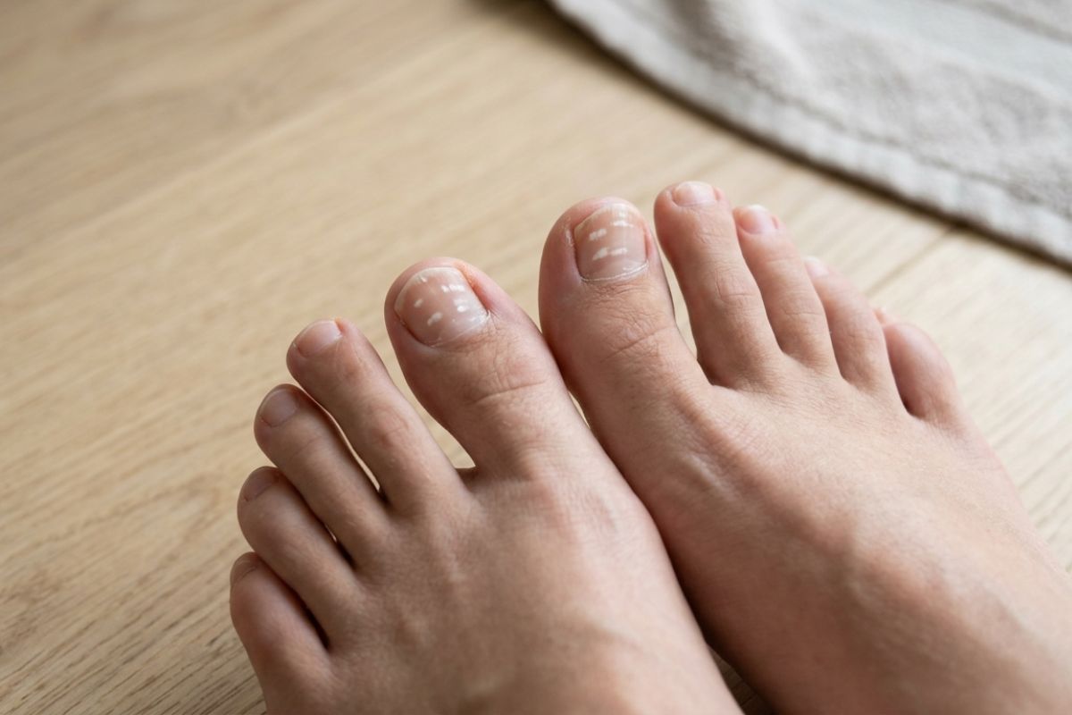 Unhas com manchas branca nos pés: o que pode ser? 1 Unhas com manchas branca nos pés.
