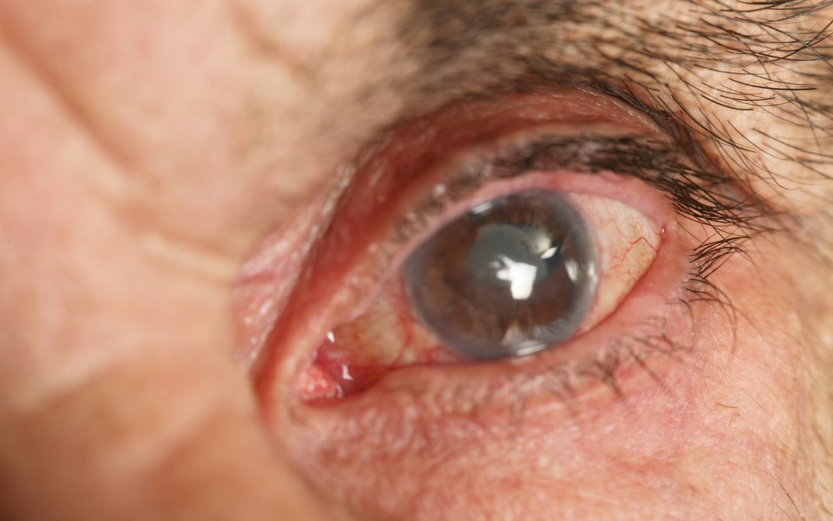 Como prevenir catarata