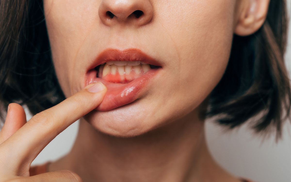 Dente mole em adultos