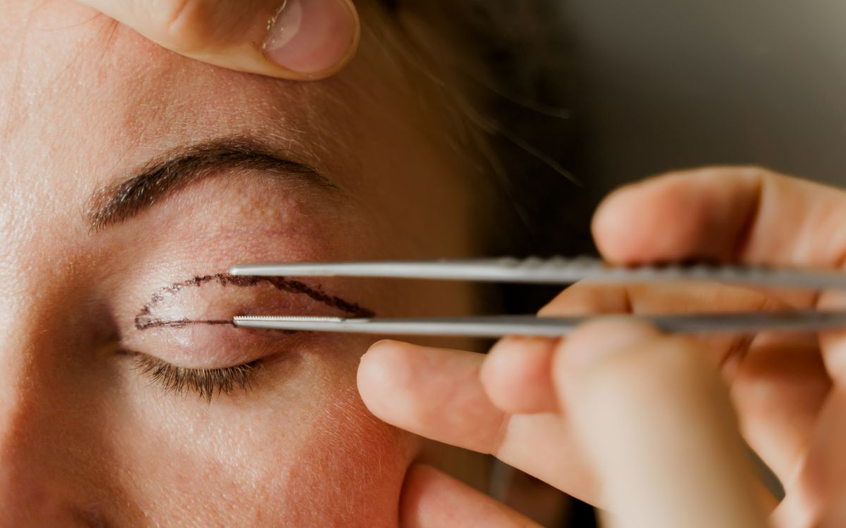 Blefaroplastia / Canva Blefaroplastia