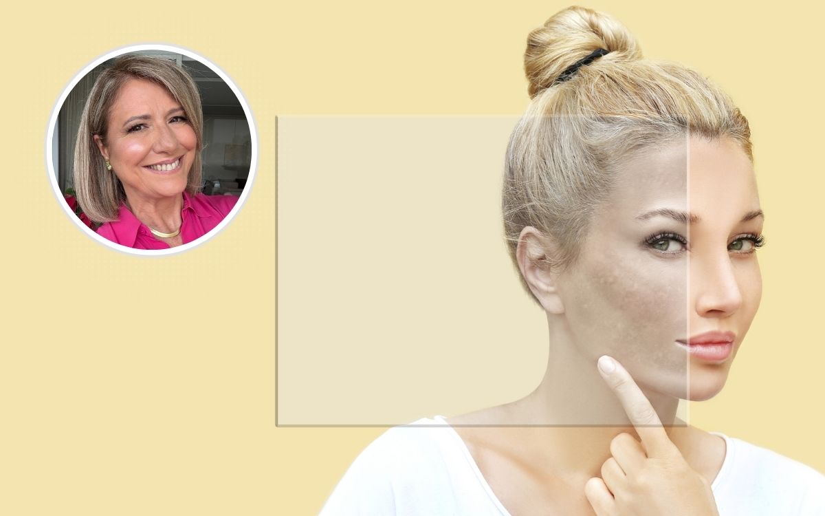 Nem só de cremes vive o tratamento do melasma: o que a alimentação pode mudar na pele 1 Alimentação para melasma.