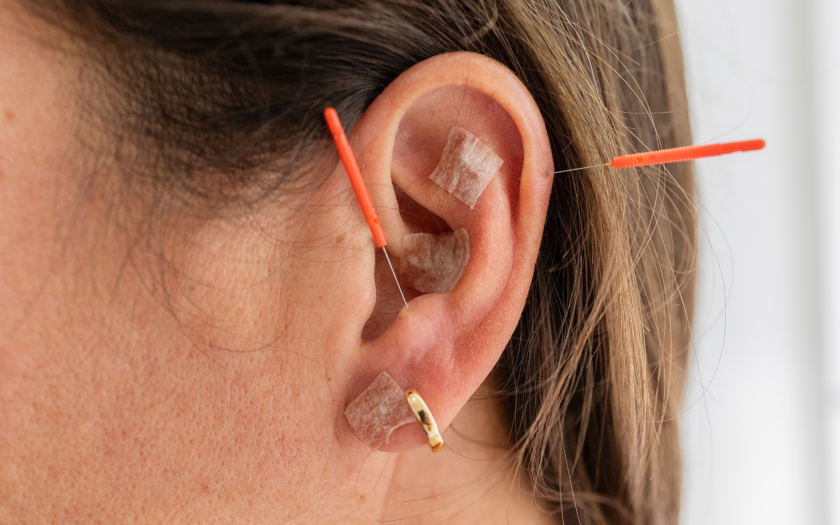 Acupuntura na orelha pode ajudar a aliviar a enxaqueca? Pesquisa brasileira investigou 1 Auriculoterapia para enxaqueca