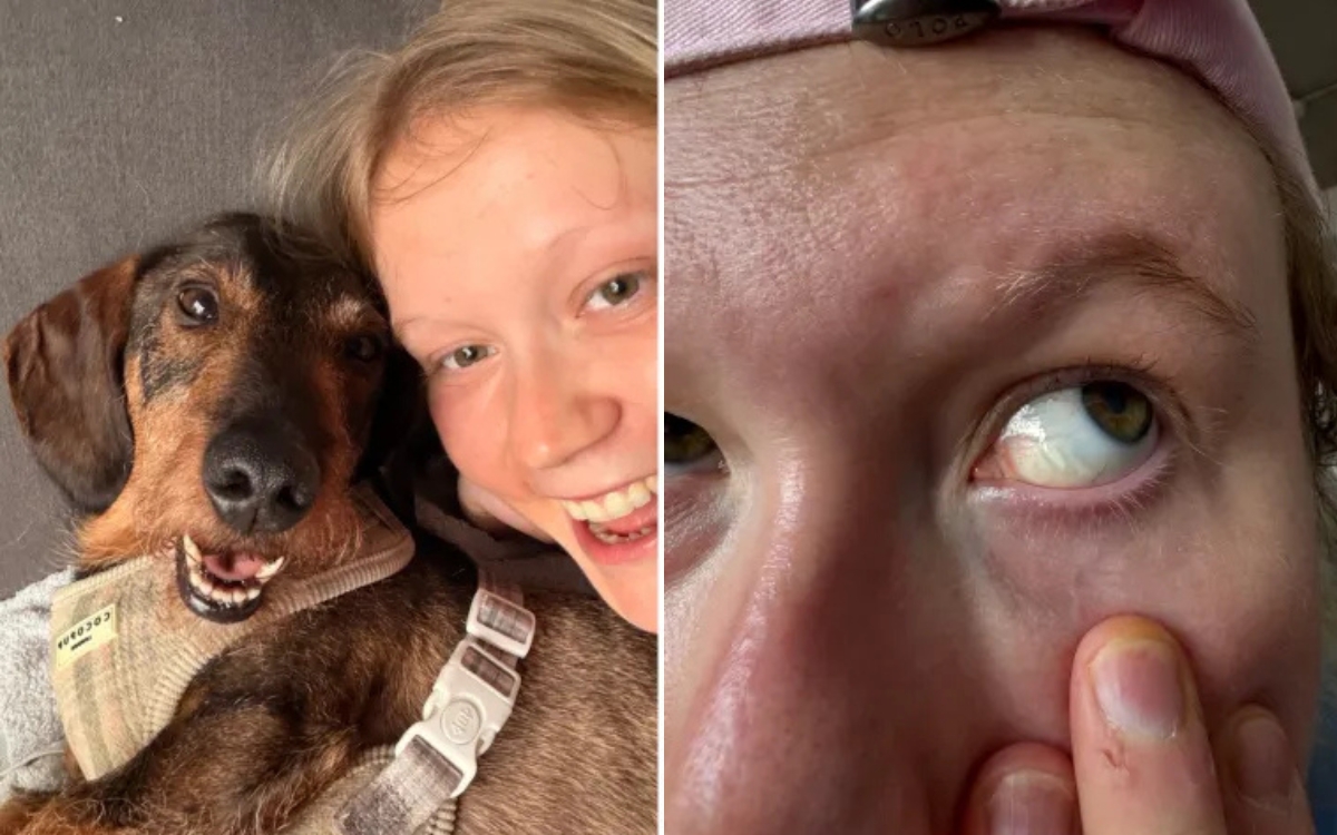 Jovem diz que "quebrou o próprio olho" após chorar pela morte do cachorro 1 Esfregar os olhos 2