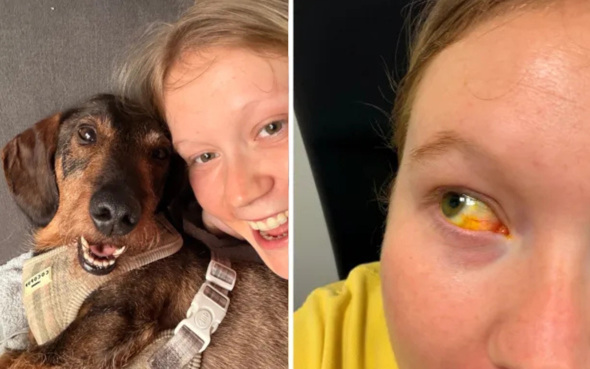 Jovem diz que "quebrou o próprio olho" após chorar pela morte do cachorro 2 Esfregar os olhos