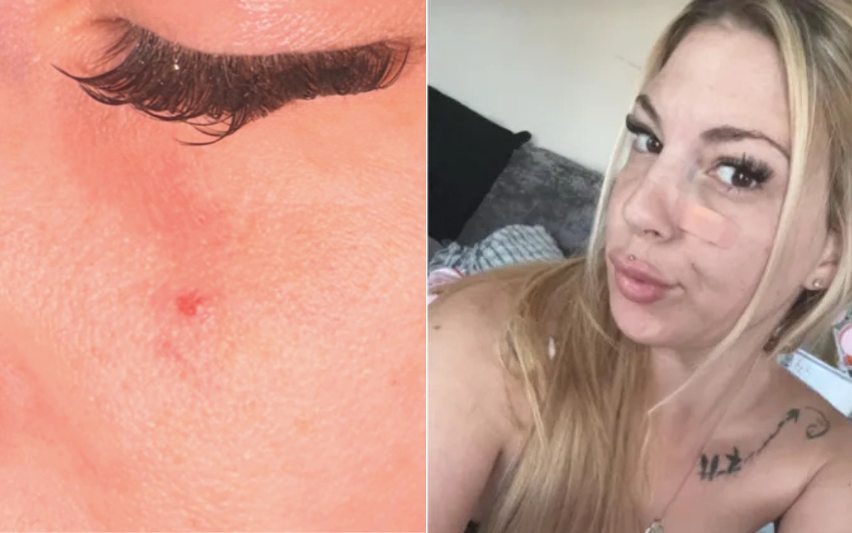 Ela conviveu anos com uma "espinha" no rosto até descobrir o que realmente era 2 Ferida que não cicatriza